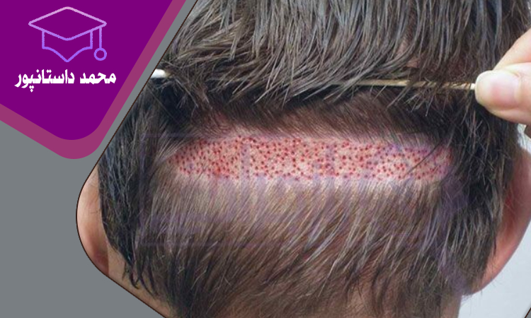 راهنمای کامل تبلیغات کلینیک کاشت مو و ابرو